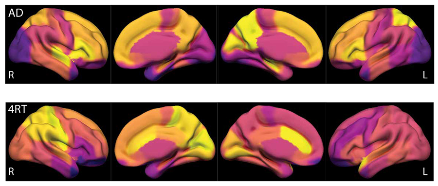 Activated microglia may be responsible for the elevated FDG signal in early #alzheimersdisease. @DZNE_de ow.ly/2GpE50GssaH