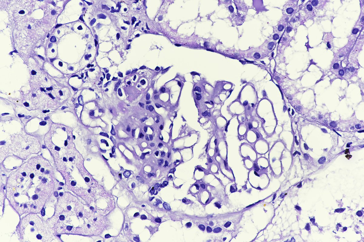 PreethiSekarMD's tweet photo. A case of Membranous nephropathy showing several intracapillary neutrophils and a thrombus. These features can be observed in the setting of renal vein thrombosis and malignancy. #renalpath #pathology https://t.co/Yd8cHkBkRh