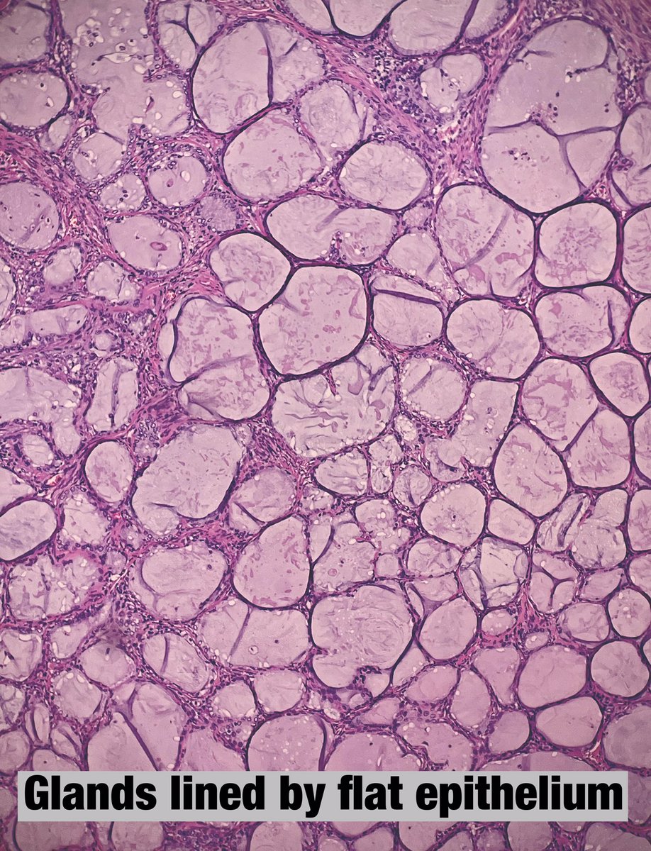 Amsangui's tweet photo. Tunnel clusters: benign cervical lesion, incidental finding, two types, A (non dilated glands) and B( dilated glands). No clinical relevance and no need to be mentioned in pathology report. Pictures from tunnel clusters type B. #PathTwitter #pathresidents https://t.co/40IagjUSCH