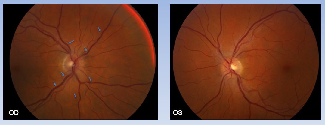 NOVEL (Neuro-Ophthalmology Virtual Ed. Library) (@novelnanos) on Twitter photo NOVEL Visual Diagnosis Challenge: What findings are seen here on the external photographs and fundus photos? What is top on your differential diagnosis? Find out these answers and more by going to:
collections.lib.utah.edu/ark:/87278/s63…
Credit <a href="/EmoryEyeCenter/">Emory Eye Center</a>
#localeyes #nanos #meded NOVEL Visual Diagnosis Challenge: What findings are seen here on the external photographs and fundus photos? What is top on your differential diagnosis? Find out these answers and more by going to:
collections.lib.utah.edu/ark:/87278/s63…
Credit <a href="/EmoryEyeCenter/">Emory Eye Center</a>
#localeyes #nanos #meded
