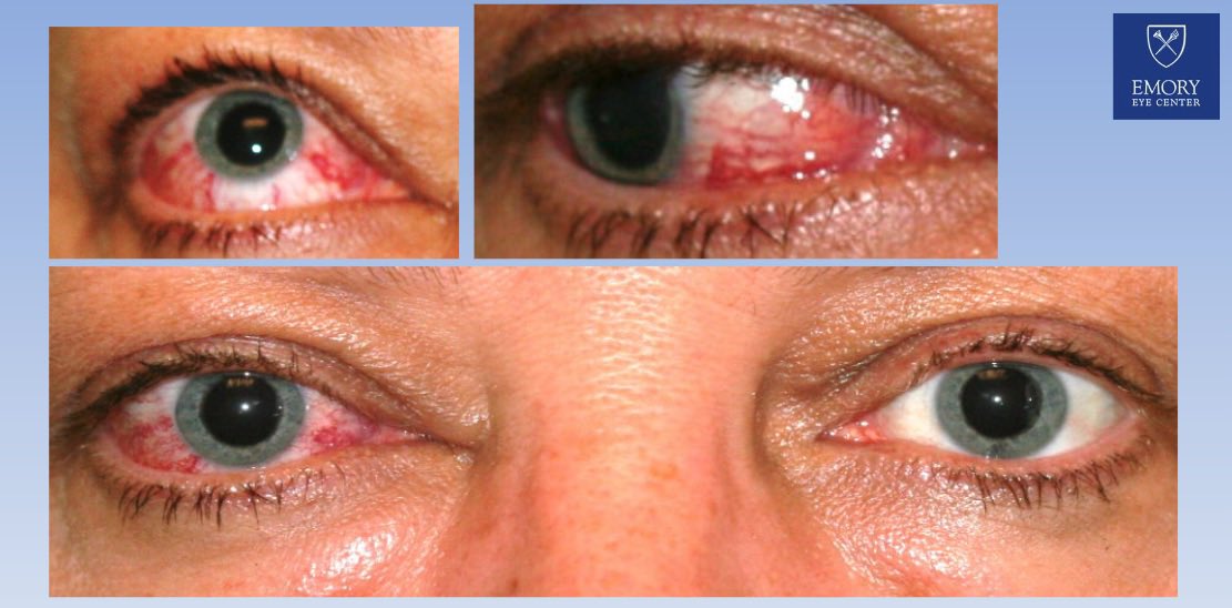 novelnanos's tweet photo. NOVEL Visual Diagnosis Challenge: What findings are seen here on the external photographs and fundus photos? What is top on your differential diagnosis? Find out these answers and more by going to: 
https://t.co/f5Q7MeTixY 

Credit @EmoryEyeCenter 

#localeyes #nanos #meded https://t.co/vCqrFgZDxF