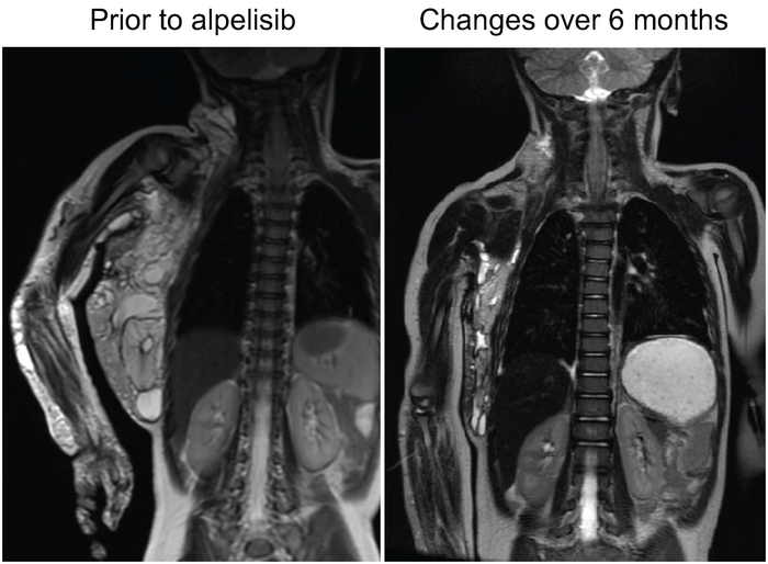 ScienceMagazine's tweet photo. Using a new genetic mouse model and MRI imaging in 6 patients, researchers in a new @ScienceTM study have discovered that the approved cancer drug #alpelisib can combat rare genetic disorders known as lymphatic malformations. https://t.co/WHP7l10XrL https://t.co/UxqDnvcQrz