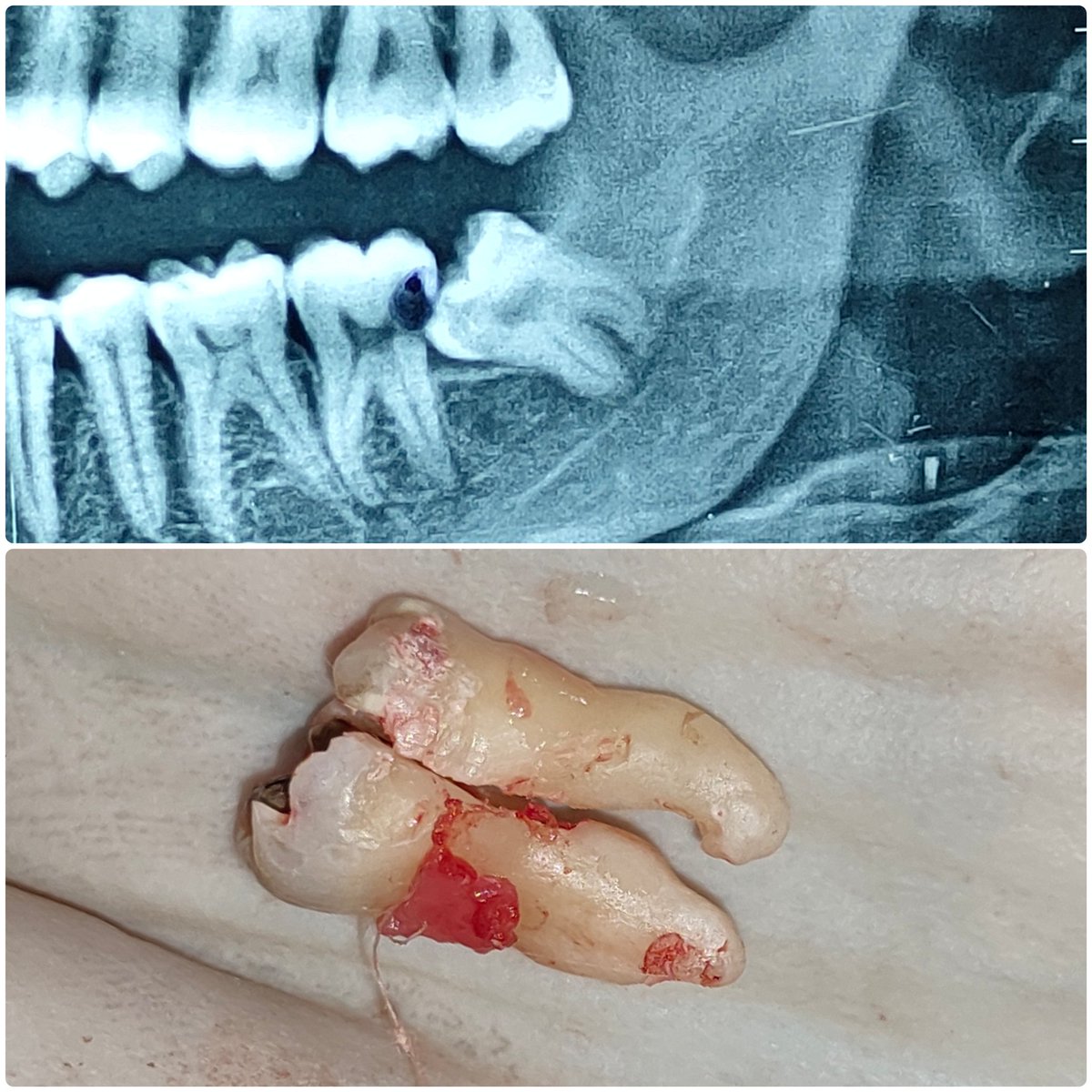 RahulThanvi's tweet photo. Mesioangular #wisdomtooth #thirdmolar #exodontia https://t.co/LtyN83s0gI
