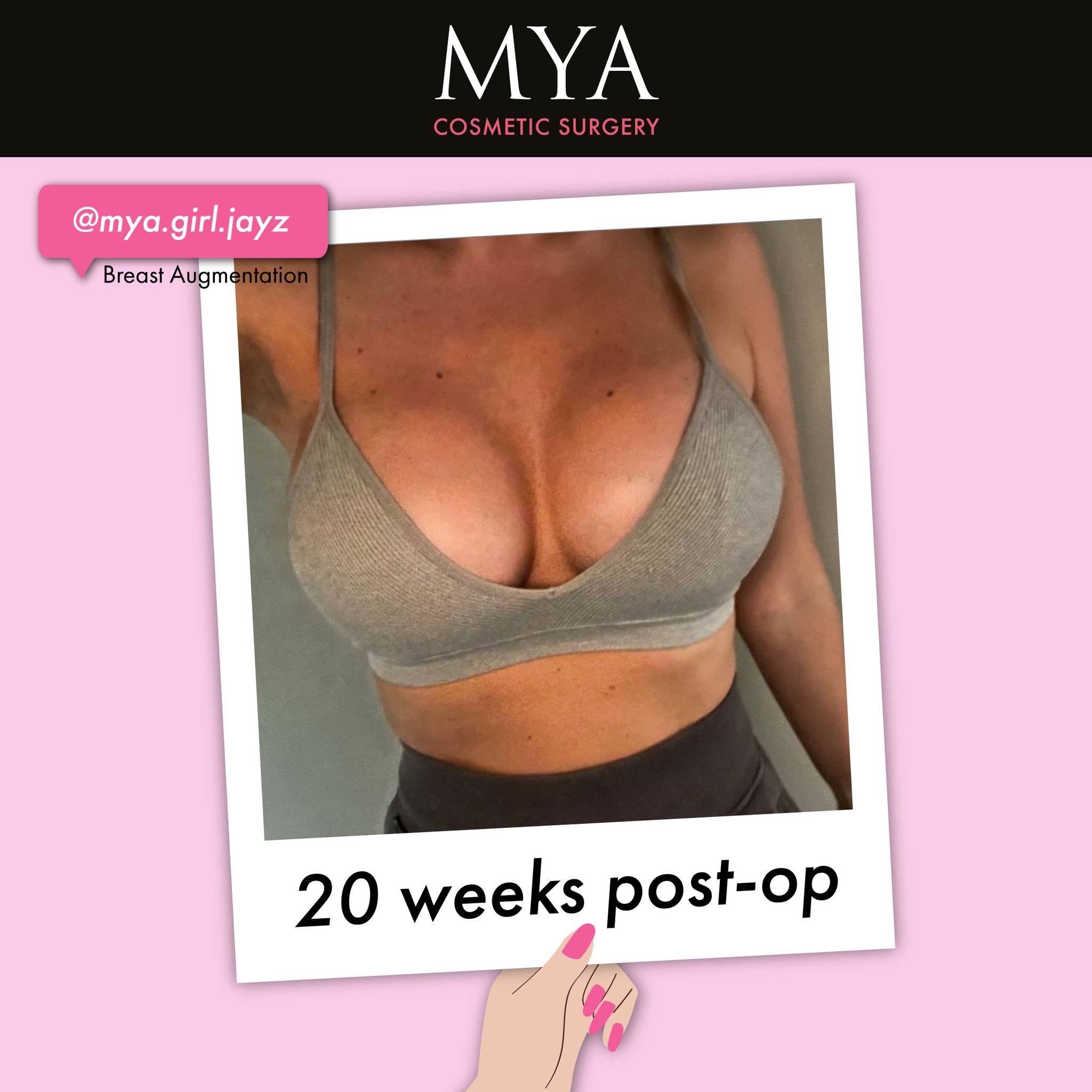 MYA Cosmetic Surgery on X: #MYAGirl mya_0721 ❤️ Breast Augmentation &  Modified Mastopexy #MYASelfie #CosmeticSurgery #Implants    / X