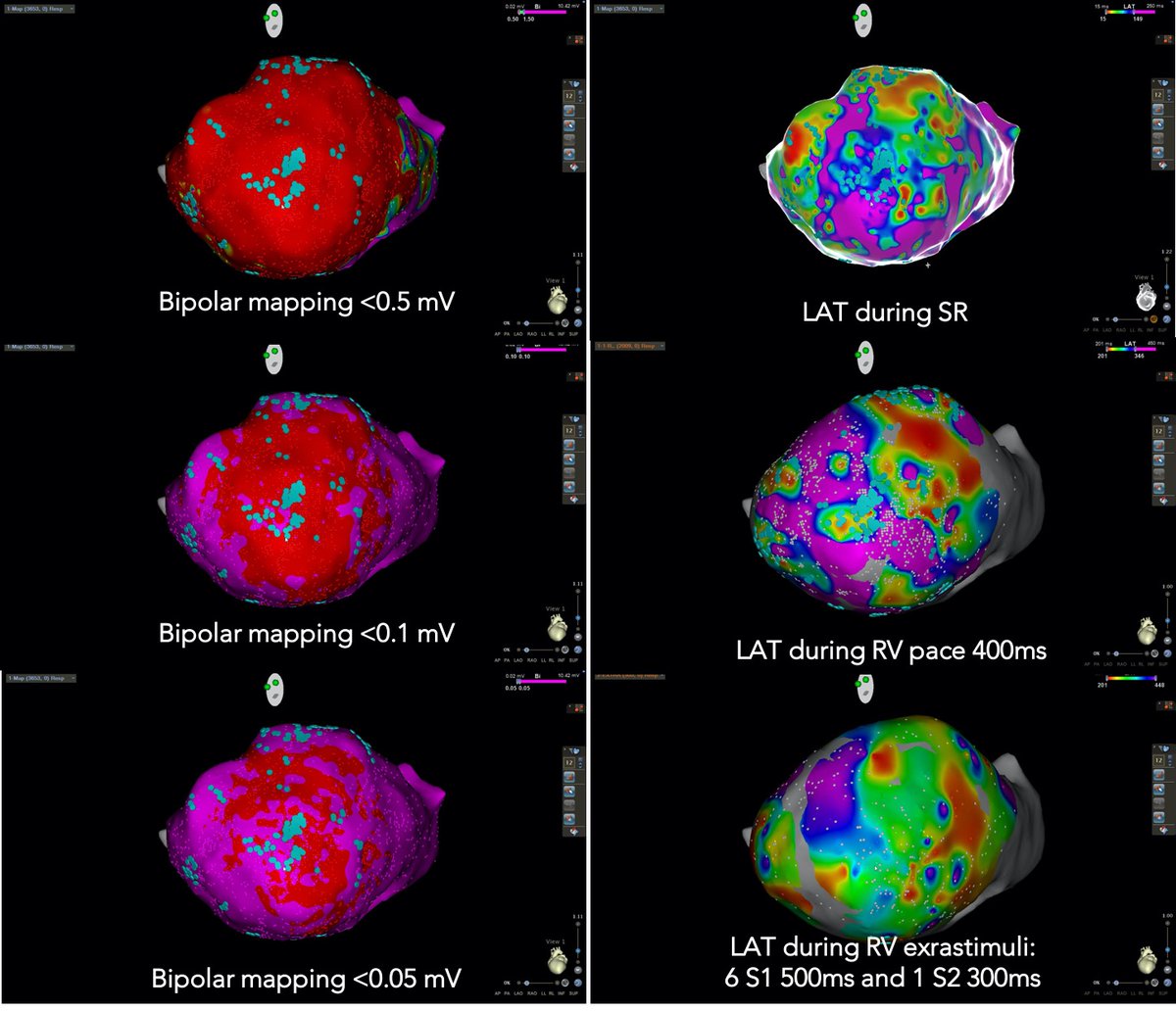 K_Letsas's tweet photo. Functional substrate mapping (DEEP mapping) for VT ablation.
@MEfraimidis @vlachoskonstan1 @SteliosDragasis @CosmoValkanas #EPeeps #parallel mapping #CARTO @BiosenseWebster Ωνάσειο Καρδιοχειρουργικό Κέντρο https://t.co/ILQDlIo1eN