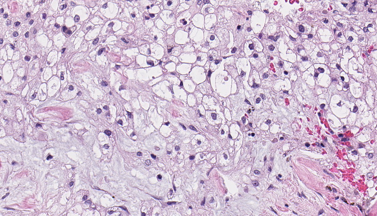 B_C_Dickson's tweet photo. CONVENTIONAL CHORDOMA. IHC: brachyury. NB: lobulated neoplasm composed of sheets of epithelioid cells; abundant and bubbly cytoplasm; round nuclei with mild atypia; and focal myxoid stroma. https://t.co/1qGb9sbzVF