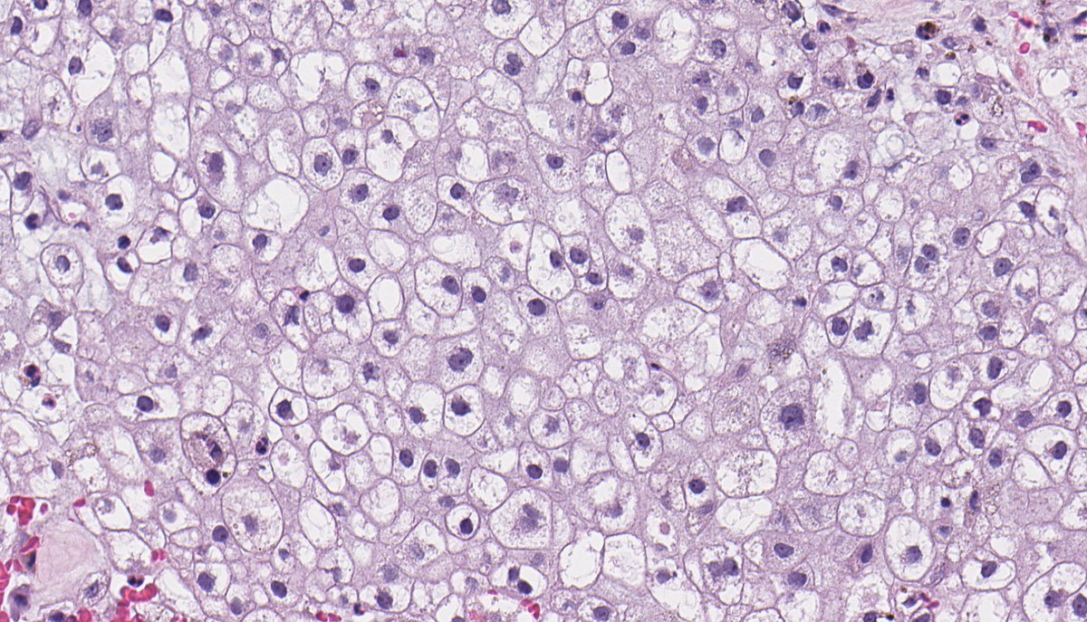 B_C_Dickson's tweet photo. CONVENTIONAL CHORDOMA. IHC: brachyury. NB: lobulated neoplasm composed of sheets of epithelioid cells; abundant and bubbly cytoplasm; round nuclei with mild atypia; and focal myxoid stroma. https://t.co/1qGb9sbzVF