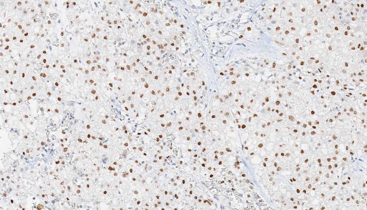 B_C_Dickson's tweet photo. CONVENTIONAL CHORDOMA. IHC: brachyury. NB: lobulated neoplasm composed of sheets of epithelioid cells; abundant and bubbly cytoplasm; round nuclei with mild atypia; and focal myxoid stroma. https://t.co/1qGb9sbzVF