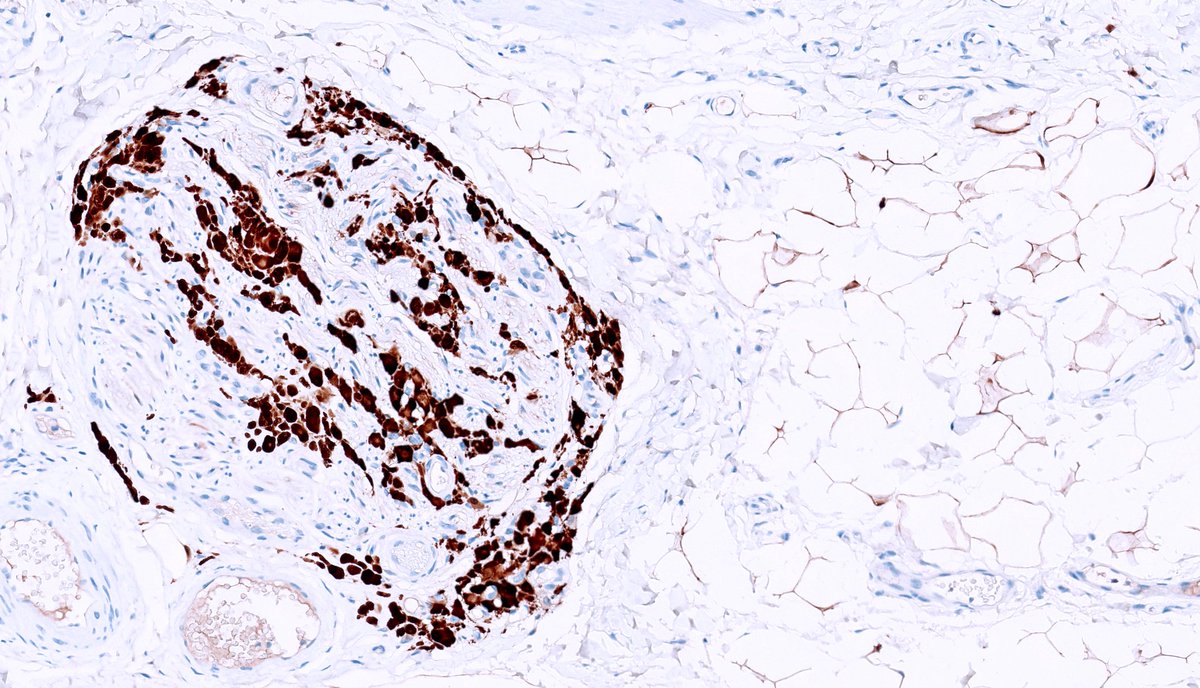 kis_lorand's tweet photo. A tiny #pathquizz 😁
What could be the location of this lesion?
An IHC might help...
#Pathology #IHCpath https://t.co/DCWg4c3VRv