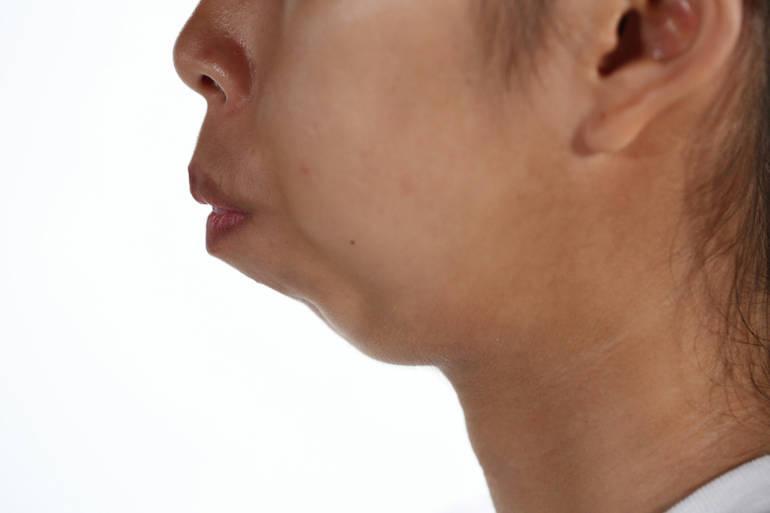 Выступающий подбородок. Выступающий подбородок. Липосакция подбородка. Неправильный прикус мезиальный. Недоразвитый подбородок.