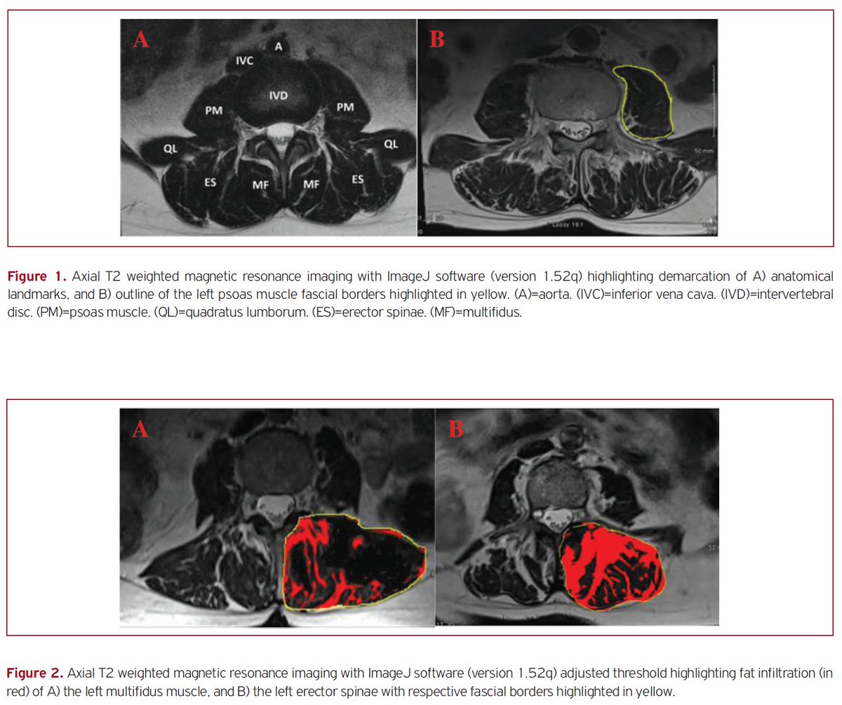 TCDGerontology's tweet photo. Radiological assessment of sarcopenia in older patients with chronic back pain: degree of fat infiltration in paraspinal muscles may be an indicator
https://t.co/XExGsUHanb @jfsf_journal @DenysGibbons @JakeMc_D @dpahern @cunniffg @RoseAnnekenny1 @ProfOrtuno Joseph Butler @NSIURG https://t.co/BLMp4YIeAr