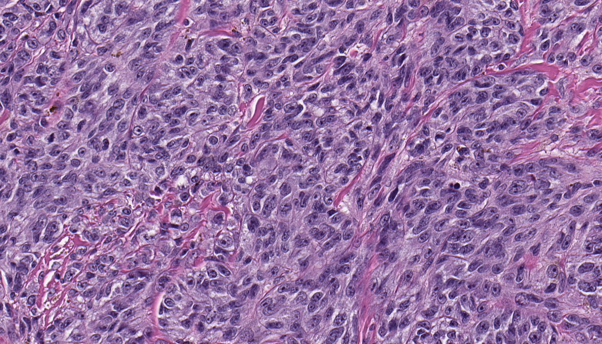B_C_Dickson's tweet photo. CLEAR CELL SARCOMA. IHC: HMB45. NGS: EWSR1-ATF1. NB: fascicles of spindle-epithelioid cells separated by thin fibrous septa; amphophilic cytoplasm; ovoid nuclei with prominent small nucleoli; scattered pigmentation. https://t.co/9s8dUm7CON
