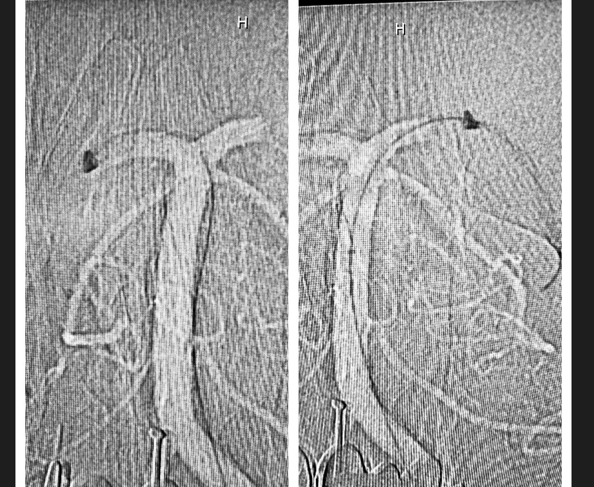 Not your typical #thrombectomy in time for #worldstrokeday tomorrow. Surprised we don’t see more bilateral P1 occlusions from clot splitting on impact at basilar tip. @svinsociety #NoLVOLeftBehind @imperative_care @Rapid__Medical @BCMNeurosurgery @WorldStrokeEd @YoungNIR