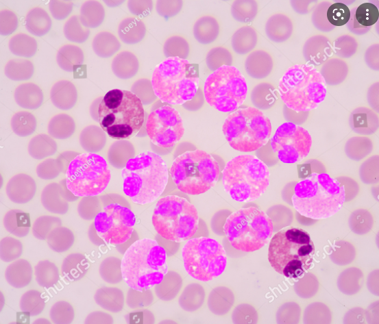 Clonal eosinophilia 

FIP1L1-PDGFRA= CHIC2 del= imatinib 100
ETV6-PDGFRB = t(5;12)= imatinib 400
ZMYM2-FGFR1= t(8;13)= TKI+AML/ALL induction+allo
PCM1-JAK2= t(8;9)= ruxolitinib+allo
ETV6-FLT3/ABL1= t(12;13)/t(9;12)= dasatinib+allo

Lymphocytic= T-cell clone makes IL5= mepolizumab