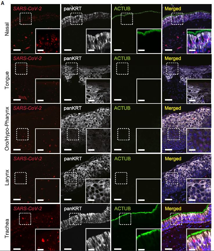 IvanLeeMDPhD's tweet photo. @SizunJ @HisaNakayama @DrYanENT @WCT_Cilia @GarryPNolan Using in situ hybridization @ACDbio combined with immunofluorescent IHC staining, we discover that SARS-CoV-2 has a strong preference to replicate in the nasal cavity &amp; trachea. In layperson terms, #MaskUp over the nose when indoors =) https://t.co/zoKGHgdg18