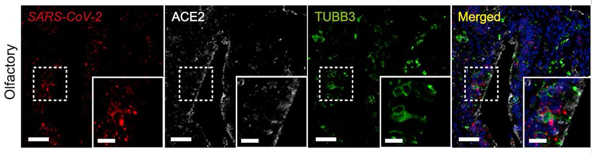 IvanLeeMDPhD's tweet photo. @SizunJ @HisaNakayama @DrYanENT @WCT_Cilia @GarryPNolan @ACDbio We also show a rare image of #SARSCoV2 infection in human olfactory tissue. This was made possible through the hands of the talented rhinologist @DrYanENT (extremely difficult to sample intact human olfactory tissue). #anosmia is a common &amp; often lasting symptom of COVID-19 https://t.co/wjZErtycLH