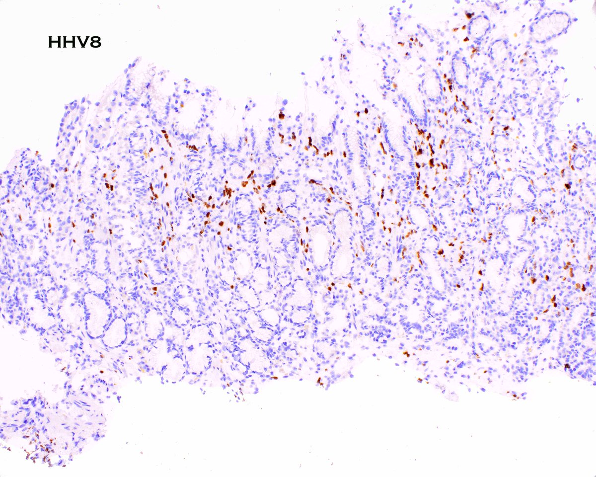 LizMontgomeryMD's tweet photo. ...sneaky sneaky.  Kaposi sarcoma in gastric mucosa. https://t.co/PxL3zm07jw