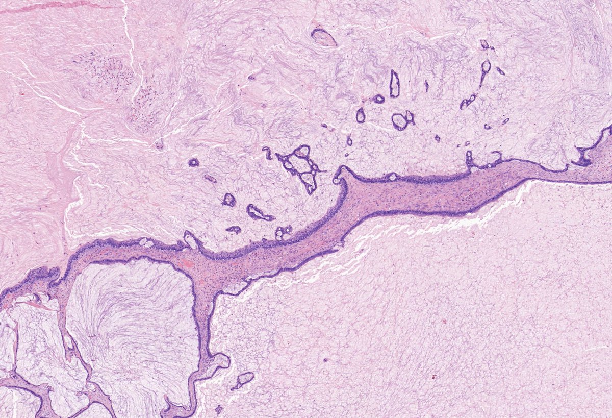 TristanRutland7's tweet photo. Ovary, multiloculated cyst
Adult.

#GYNpath #Pathtwitter #Pathresidents https://t.co/4D7yp0FYR1