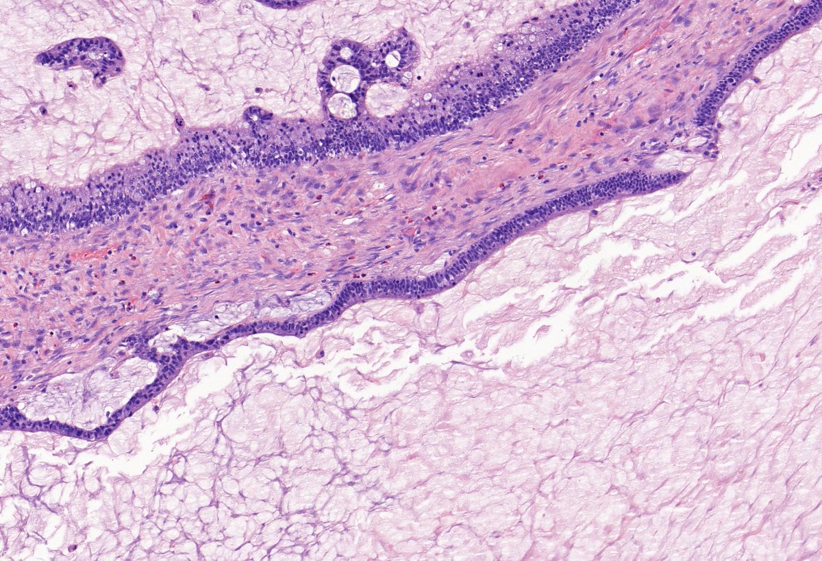 TristanRutland7's tweet photo. Ovary, multiloculated cyst
Adult.

#GYNpath #Pathtwitter #Pathresidents https://t.co/4D7yp0FYR1