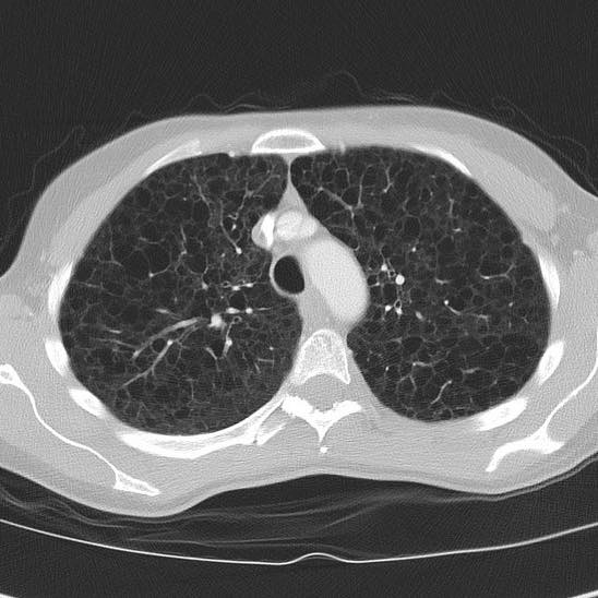 Radiopaedia's tweet photo. Q: 45yo female who has never smoked. What’s the likely diagnosis?
ANSWER: https://t.co/uN03rNmzIB
#FOAMrad #FOAMed https://t.co/dqWzIdOnJX