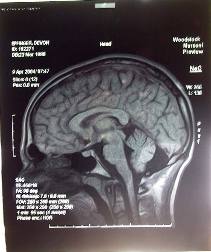 devin_effinger's tweet photo. At 15, I hit my head so hard I had to relearn how to talk. Interestingly, pre-TBI, I loved to draw and hated math/science. Post-TBI, I abruptly stopped drawing and, after 2 yrs of special ed., I developed a love for science. Now I’m pursuing a biomedical PhD. Pretty crazy, right? https://t.co/A7y3gblqdY