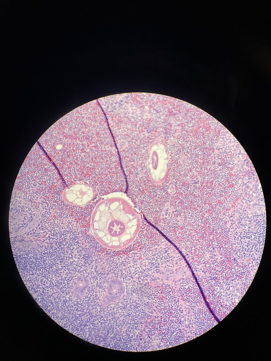 First time seeing these little things. Learnt of them in from public health class. Did not think they are in the USA. 😂 Pediatric appendix specimen.