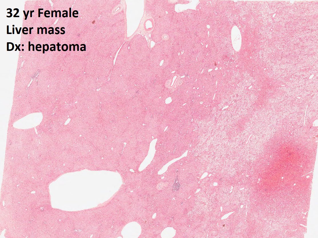 DrTravisBrown's tweet photo. Histology liver flash card

Hepatoma

Rare
Assoc ♀on OCP

Usually solitary (70-80%)
Can be asymptomatic
Presentation abdominal mass/pain

Can spontaneously rupture
Av 5-15cm mass

Histo
Tightly packed hepatocytes
Sinusoids compressed
No portal triads/central vein

#PathTwitter https://t.co/no4LnshjT4