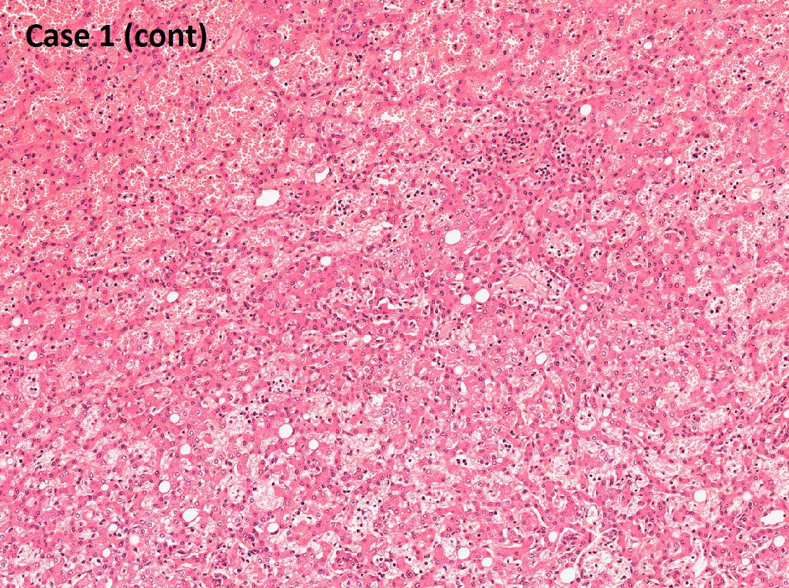 DrTravisBrown's tweet photo. Histology liver flash card

Hepatoma

Rare
Assoc ♀on OCP

Usually solitary (70-80%)
Can be asymptomatic
Presentation abdominal mass/pain

Can spontaneously rupture
Av 5-15cm mass

Histo
Tightly packed hepatocytes
Sinusoids compressed
No portal triads/central vein

#PathTwitter https://t.co/no4LnshjT4