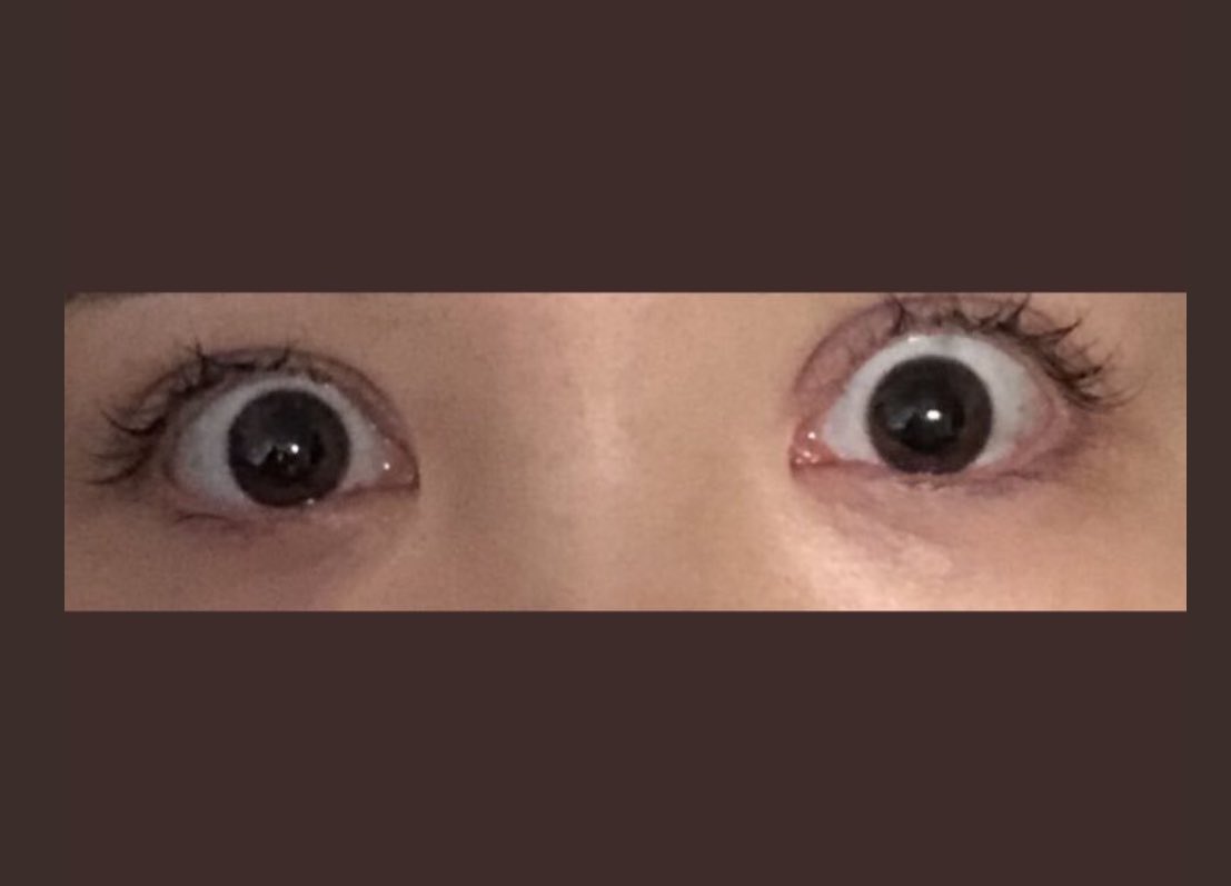 tttttyru's tweet photo. こんな目にした名古屋のヤブ医者マジで死ぬまで呪う
(見開かなくてもこんなに開いてしまう)
名前出したら速攻弁護士から手紙届くから書けない…

まだ完璧ではないけど、
全国回って断られ続けたこの眼を
「僕がやらないと誰がやるんですか」と手を差し伸べてくれた今の主治医には
本当に感謝しかない https://t.co/trBWnMtwBA