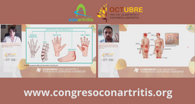 ConArtritis's tweet photo. Hoy #DíaMundialdelaArtritisPsoriásica os recomendamos que veáis las ponencias de
@mariaj_morenom y @Alvaro_Gonza que dieron en nuestro I Congreso de Personas con artritis y espondiloartritis hablando de la #artritispsoriásica
https://t.co/FymqecL31j
#OctAR21 https://t.co/Cnjbeq6CxM