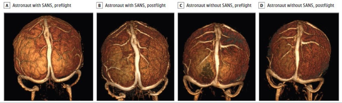 <a href="/JAMANetworkOpen/">JAMA Network Open</a> <a href="/MUSCNeurorads/">MUSC Neuroradiology</a> <a href="/MarkRosenbergMD/">Mark J Rosenberg, MD</a> <a href="/samialkasab/">Sami Al Kasab</a> <a href="/_brainwave/">Heather Collins, Ph.D.</a>