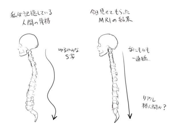 「ストレートネックになってそうだな～」とは思っていましたがよもや椎骨のはじまりから終わりまでもが一直線になってしまっているとは思わなかった 「外側からのパッと見では中がそうなっているとはわからない」と人からも言われたのでMRI検査で問題が発覚して良かったです…  改善に励むのみです…… 