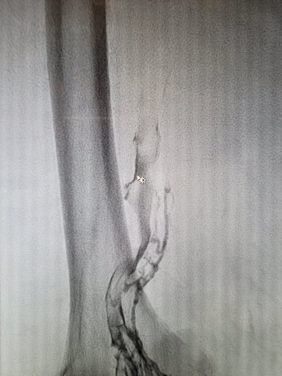 JongParkIR's tweet photo. 74 with thrombocytopenia and cannot get anticoagulation presenting with left leg DVT and in transit PE @PenVascular #MedTwitter #irad @SIRspecialists @SIR_ECS https://t.co/s2g0rLgAiE