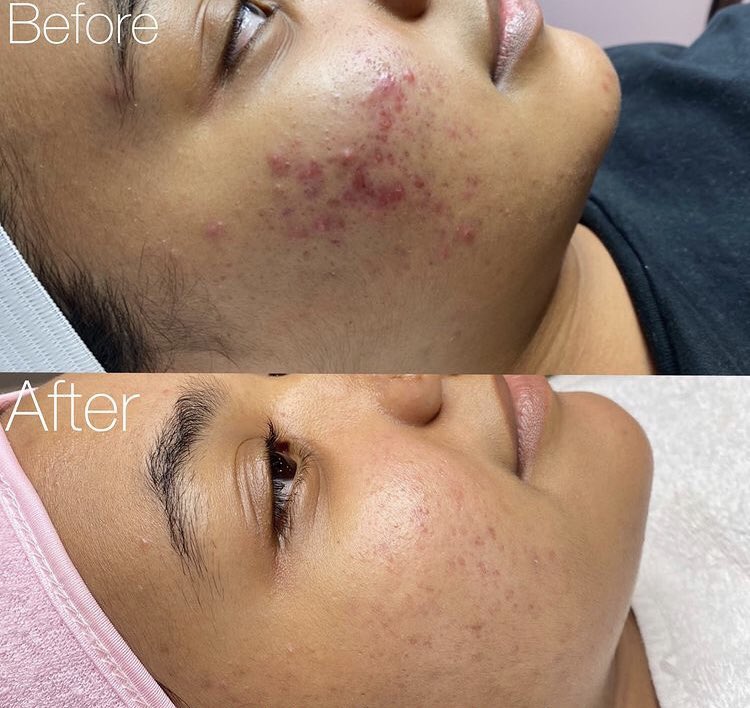 RefineClinicUG's tweet photo. It’s #PeelSaturday tomorrow🤲🏽🤲🏽
🦋 Consultation + Chemical Peel - UGX 80,000
🦋 Consultation + Chemical Peel + Sunscreen - UGX 150,000
📞 0758 232 889.
Don’t miss🤗🤗
#BeFlawless #ChemicalPeel #ChemicalPeelSaturday #Sunscreen #SkinGoals #Refine #GetRefined https://t.co/vIzEAx2JZe
