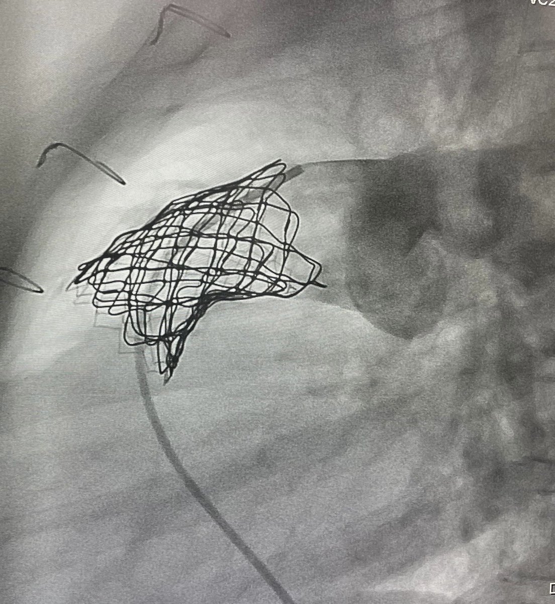CorazonHuvr's tweet photo. Colaboración de las unidades de Hemodinámica Infantil-Adultos en implante de válvula pulmonar en una niña de 11 años. @FelixCoserria @doctoraguillen @Monicaferqu @pericoagudo   Dr Zunzunegui @HospitalUVRocio https://t.co/T2ppx3nzPp