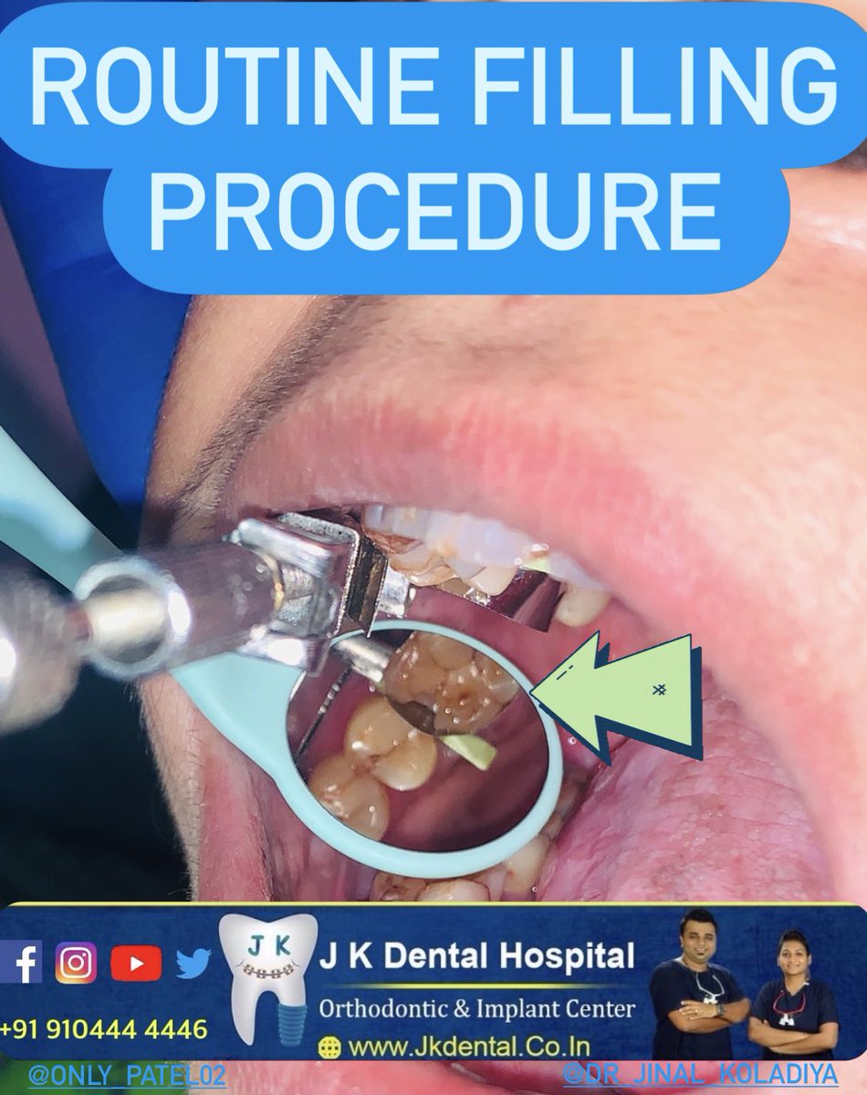 JKDENTALORTHO's tweet photo. Routine tooth coloured filling is being done in this particular pic.
Tooth coloured dental filling is done in the tooth when tooth is decayed.
Visit @JKDENTALORTHO for your one step dental solution.
#ahmedabad #chandkheda #dentist #orthodontist #newcgroad #motera #braces https://t.co/6sSCQ62521