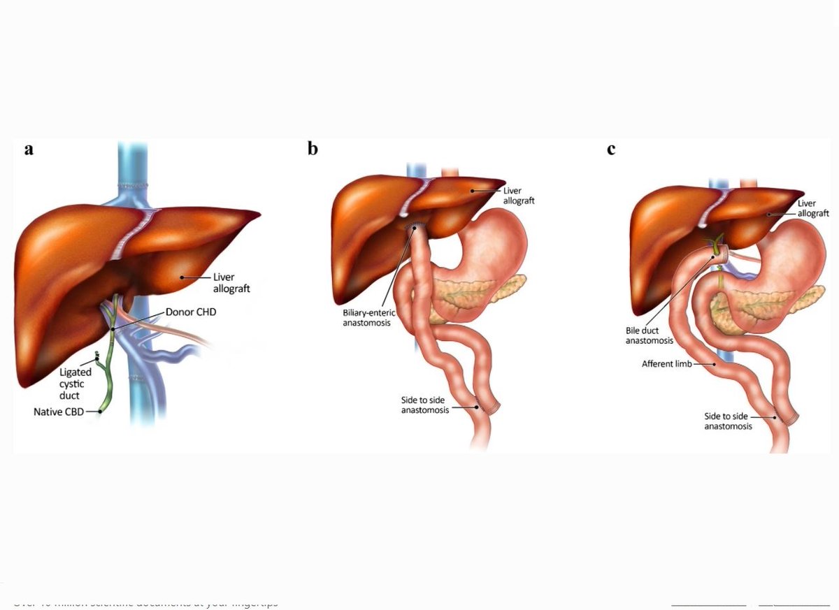 Eric Monroe, MD (@eric_monroe_md) on Twitter photo Evaluation and management of #biliary complications after pediatric liver #transplantation: pearls and pitfalls for percutaneous techniques <a href="/PedRadJournal/">Pediatric Radiology</a>
link.springer.com/article/10.100…
<a href="/socpedsir/">SPIR</a> <a href="/VYoungMD/">Victoria Young</a> <a href="/CHICKVIR/">Jeffrey F. B. Chick, MD, MPH</a> <a href="/woerner_md/">Andrew Woerner, MD</a> <a href="/davidsshin/">David Shin</a> #pedsIR Evaluation and management of #biliary complications after pediatric liver #transplantation: pearls and pitfalls for percutaneous techniques <a href="/PedRadJournal/">Pediatric Radiology</a>
link.springer.com/article/10.100…
<a href="/socpedsir/">SPIR</a> <a href="/VYoungMD/">Victoria Young</a> <a href="/CHICKVIR/">Jeffrey F. B. Chick, MD, MPH</a> <a href="/woerner_md/">Andrew Woerner, MD</a> <a href="/davidsshin/">David Shin</a> #pedsIR