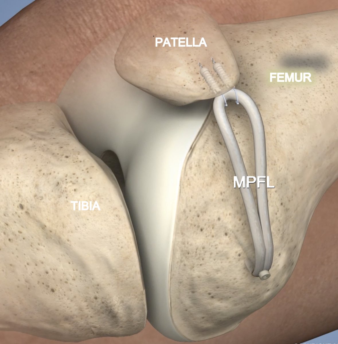bethshubinstein's tweet photo. Failing to recognize/address lower limb malalignment in #patellofemoral #instability can be a recipe for poor surgical outcomes! @SmyL_NY and I have combined the worlds of sports and limb lengthening to successfully address #complexPFinstability! #PF360
https://t.co/QEck9grfEv https://t.co/n9UIk6kNPx