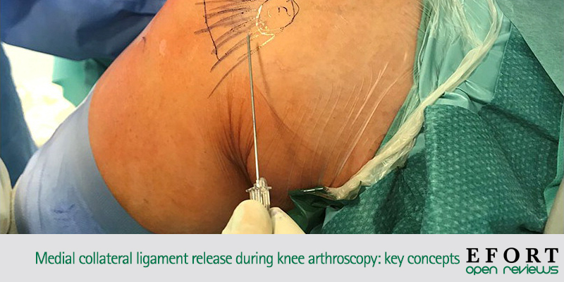 EFORTnet's tweet photo. There are 2main techniques to perform medial collateral release: inside-out & outside-in. Releasing medial #ligament structures is a safe/effective method to be used in treatment of injuries to #medialcompartment ๐ https://t.co/A3Qn9zkXxu #orthotwitter #arthroscopy #OpenReviews https://t.co/LIDU8PAXMd
