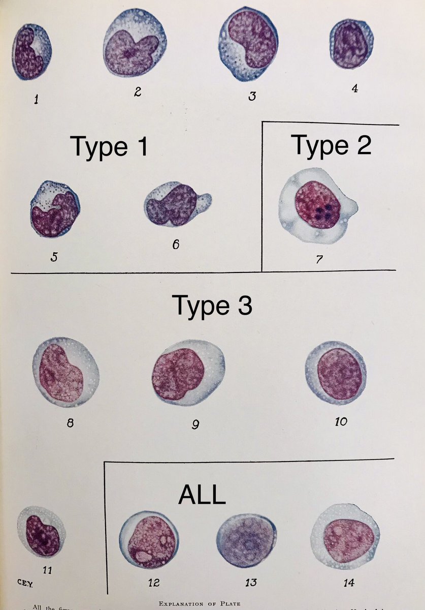 mnhemepath's tweet image. Another #hemepath legend of MN.  Dr. Hal Downey.  This work was published in 1923 and Dr. B gave me original reprints.  In case you want to describe Downey I, II, or III type lymphocytes