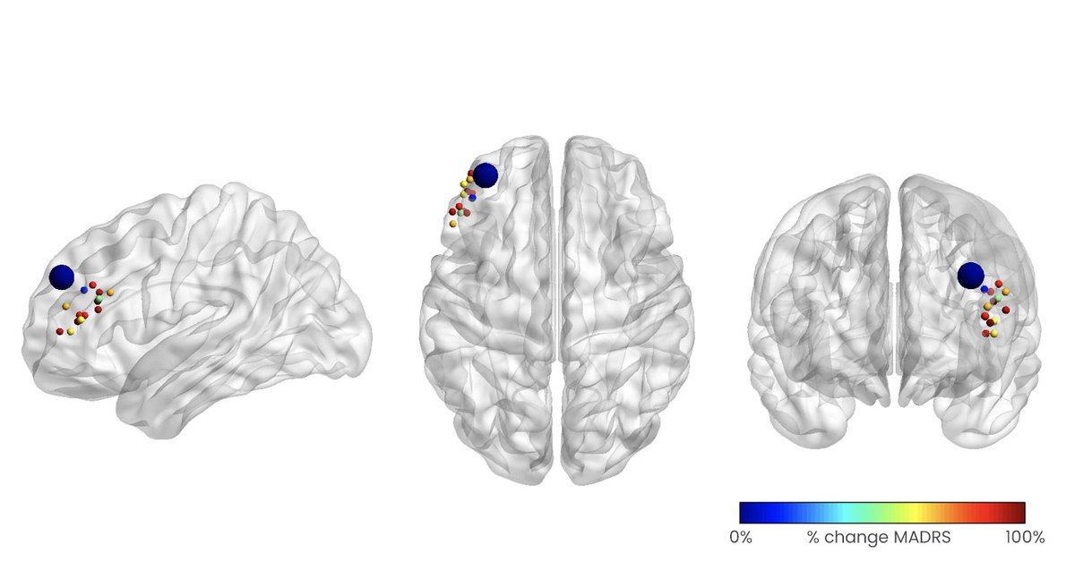Stanford_BSL's tweet photo. Encouraging data in @APAPubJournals from our double-blinded RCT evaluating Stanford Neuromodulation Therapy (SAINT) for treatment-resistant #depression. After 5 days, 79% in the active group achieved remission from depression compared to 13% in sham
https://t.co/cTOMIO1W2l https://t.co/hzJ5llxtYm
