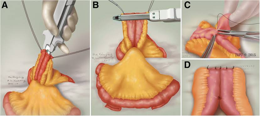 almagoch's tweet photo. Cicatrización de una #anastomosis: 
• Halsted 1882 - El contenido de colágeno en la submucosa le da su resistencia.
• 3 fases: Inflamación, Proliferación y Remodelación
• Lembert 1826 - La serosa sostiene mejor los puntos que las capas musculares. 
> Fuga en recto y esófago https://t.co/hIhxm2COey