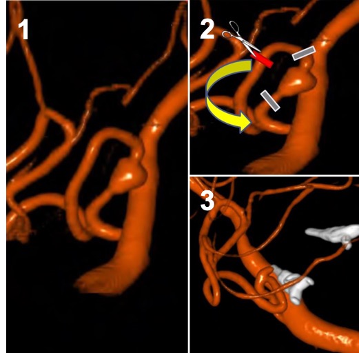 jerjohnson's tweet photo. Ruptured dissecting intracranial aneurysms are rare but often require occlusion of the diseased vessel segment.  One tx option, aneurysm trapping and artery to artery bypass, is highlighted in this ruptured PICA aneurysm operative @NeurosurgeryCNS case: 
https://t.co/4VoKRUEvZ9 https://t.co/9rYlaJ91YA