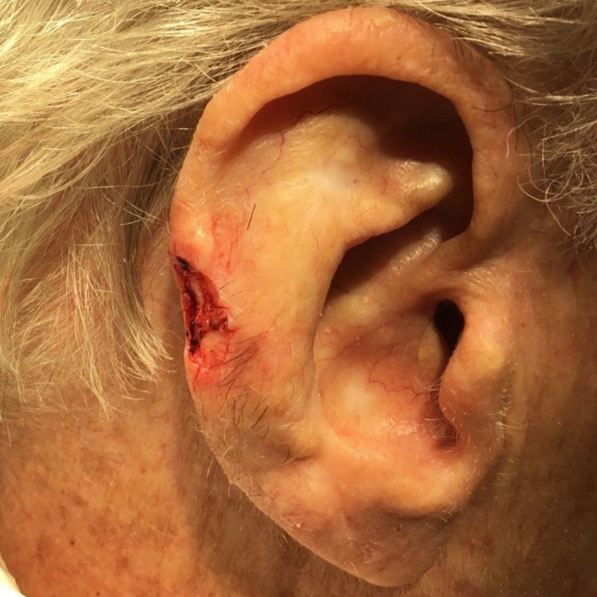 MohsCollege's tweet photo. #FlapFriday- This patient had a Basal cell carcinoma involving the helical rim. After two stages, we have a potential notch with exposed cartilage. Lower ear is my go-to for skin recruitment, and the helical advancement flap can preserve the contour and allows for... https://t.co/QDVgqlyex2