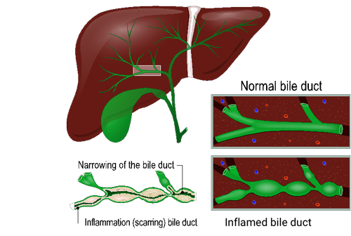 How are we hoping to help #PSC patients manage their chronic liver condition? By developing a well-tolerated drug for the difficult-to-treat #raredisease, which currently has no approved therapy. Check out the latest clinical trial results: ow.ly/x4fa50GAP2q #PSCAware