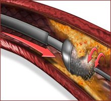 DrDeepakKrishn1's tweet image. The other approach is a rotablator which is basically a diamond coated drill with which you can drill into the calcium and clear blockages. But it cannot be used in acute heart attacks. More for chronic blockages. #Rotablation #MedTwitter #cardiotwitter