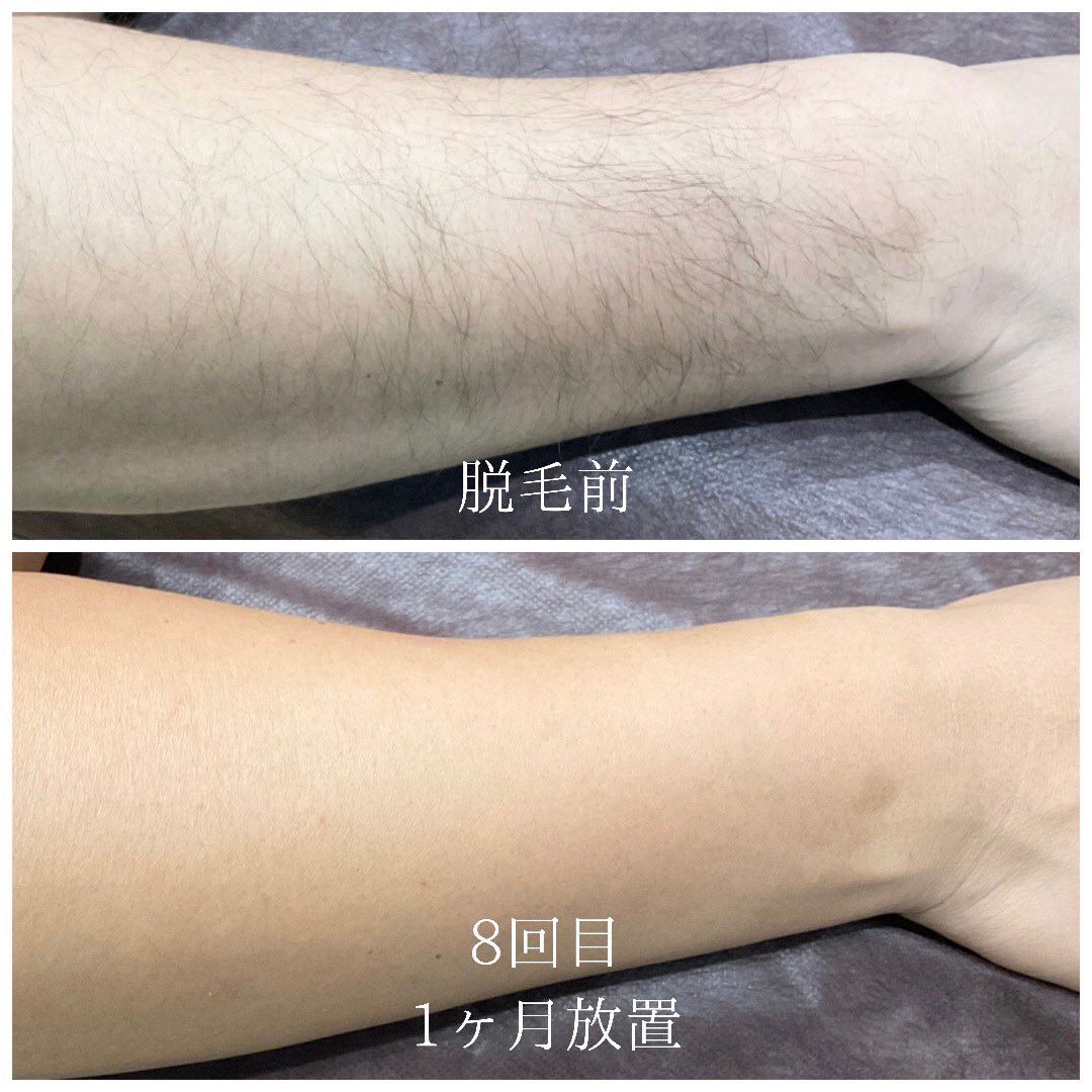 ハワイアン脱毛サロン Tiki Tiki Datsumo Twitter ハワイアン脱毛サロン Tiki Tiki Datsumo Twitter