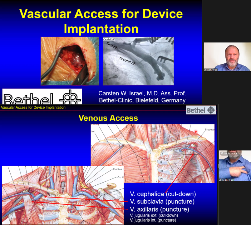 AnneNeubert1's tweet photo. 3/ Our device expert➡️Prof. Carsten Israel from Bielefeld teaches us on the Vascular Access for Device Implantation 🚪🔎
#IFPdigital #Epeeps #cardiotwitter https://t.co/OhesQnX5bw