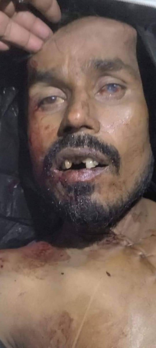 adilsiddiqui7's tweet photo. #azamgarh  के कामरान की उत्तर-प्रदेश पुलिस ने हत्या कर दी इसको इंकॉउंटर का नाम दिया जा रहा है कामरान की बदन पर चोट के गहरे निशान बयान कर रहे हैं की उनके साथ बुरी तरह से टार्चर किया गया है आगे के दोनों दाँत टूटे हुए हैं बाईं आँख फोड़ दी गई कान से खून निकल रहा है। इतनी दर्दनाक मौत https://t.co/cLfv4k8yi6