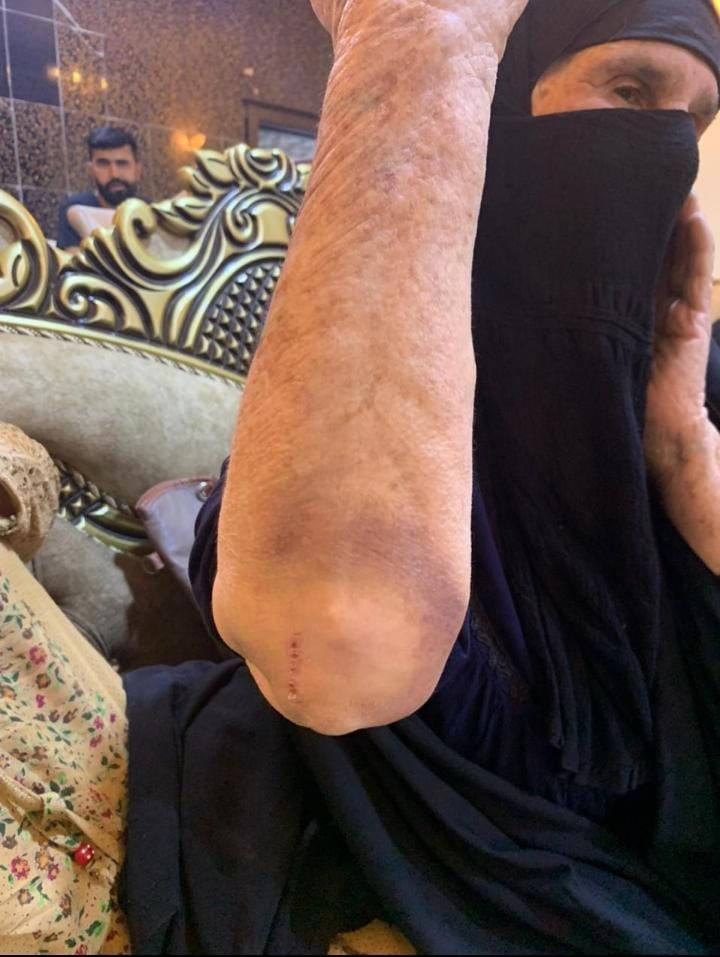 othmanmhmmadr's tweet photo. آثار ضرب وكدمات تعرضت له سيدة مسنة قبل طردهم من قريتهم (نهر الإمام) في ديالى على يد المليشيات
بحسب ناشطين عراقيين في المحافظة

#الطائفيون_يقتلون_ديالى https://t.co/730l5DCCEH
